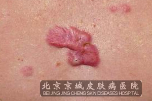 中医治疗瘢痕疙瘩