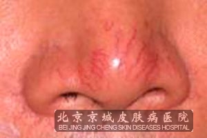 酒糟鼻和皮炎有什么区别
