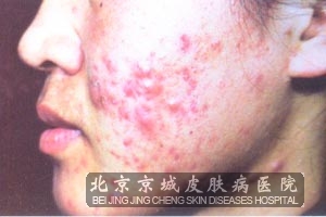 脸颊长痤疮的治疗方法