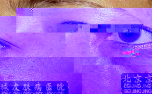 什么是汗管瘤