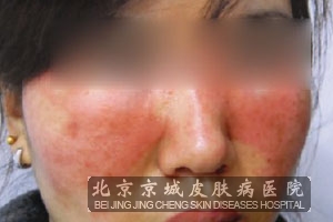 皮肤过敏的病因有什么
