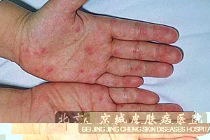 皮肤过敏有哪些症状