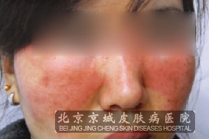 皮肤过敏怎么办
