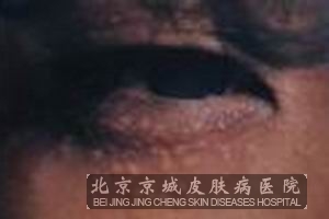汗管瘤的治疗方法