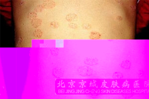体癣的诱发因素是什么