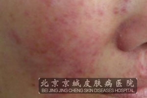 脂溢性皮炎确诊的方法是什么