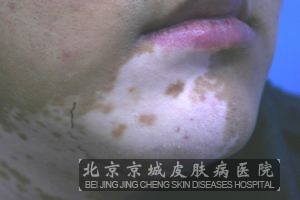 北京治疗白癜风*好的医院