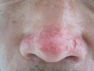 酒糟鼻中医治疗