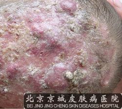 头癣的种类都有哪些