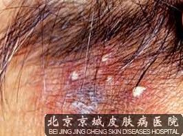 毛囊炎患者不能吃什么