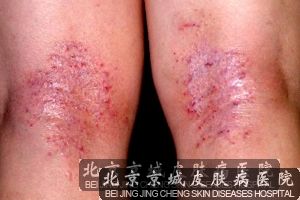 成人期异位皮炎的发生介绍 