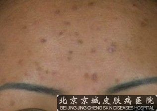 红斑痤疮发生的病因分析