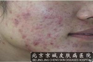 右脸痤疮的原因解析 