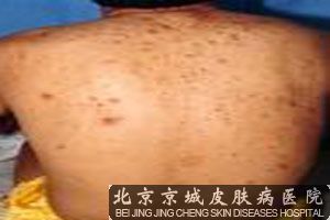 背部痤疮的原因