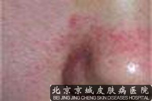 鼻子长痤疮是什么原因 