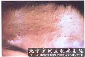 额头长痤疮的原因