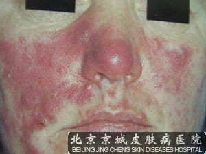 中医治疗酒糟鼻的方法都有哪些