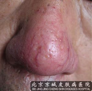 治疗酒糟鼻的方法