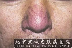 怎样治疗酒糟鼻