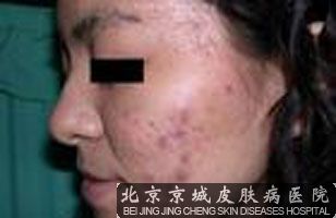 顽固性痤疮的出现与哪些因素有关