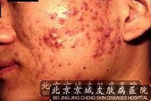 聚合性痤疮发生的影响因素分析
