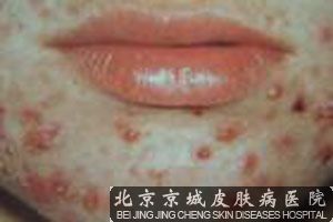 下颌长痤疮的原因及预防
