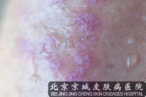 皮肤扁平苔藓病如何治疗