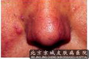 刮痧怎么治疗酒糟鼻