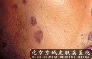 怎么治疗扁平苔藓