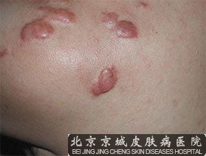 胸前瘢痕疙瘩怎么治