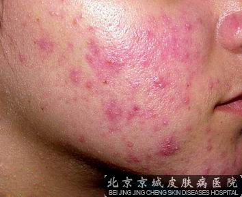 丘疹性痤疮易发人群