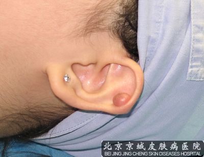 耳部瘢痕疙瘩怎么治疗