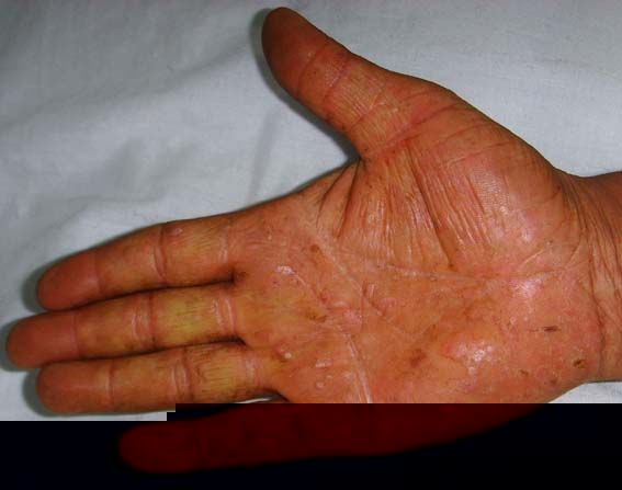 手指皮肤瘙痒的症状是什么