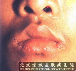 嘴角疱疹是怎么回事 