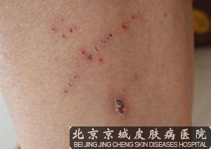 腹部皮肤瘙痒为什么越抓越痒