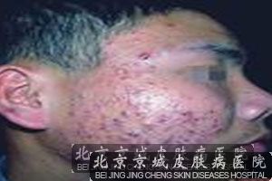 结节囊肿性痤疮的发生原因介绍