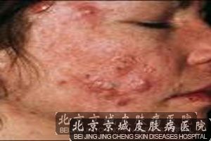 脓疱性痤疮发生的影响因素分析
