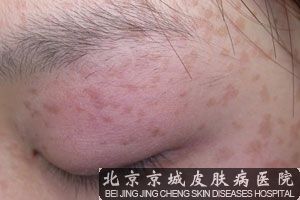 解答扁平疣的治疗方法