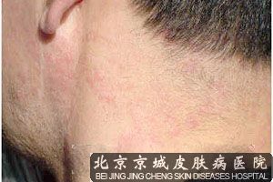 日光性皮炎的治疗