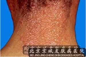 剥脱性皮炎的治疗原则分析