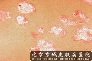 得了银屑病怎么治疗*好