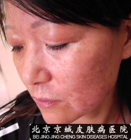 　女性白癜风的病因主要是什么