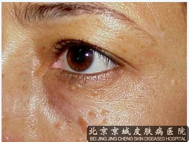 汗管瘤的护理很关键 