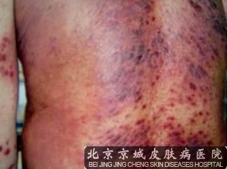 神经性皮炎的预防