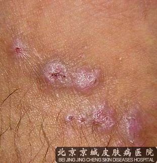 神经性皮炎的发病因素 