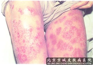 神经性皮炎会传染吗 