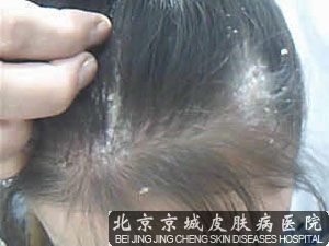 婴儿头癣该怎样治疗 - 治疗 - 头癣 - 北京京城皮肤