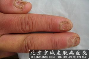 灰指甲症状是什么