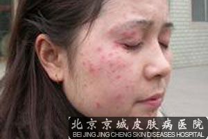 北京脂溢性皮炎怎么治疗好呢