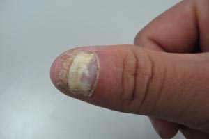 灰指甲患者需要注意什么
